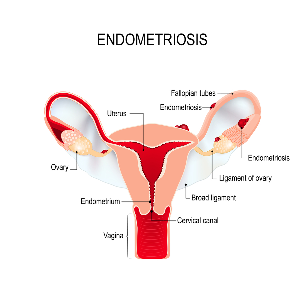 severe - period pain - treatment